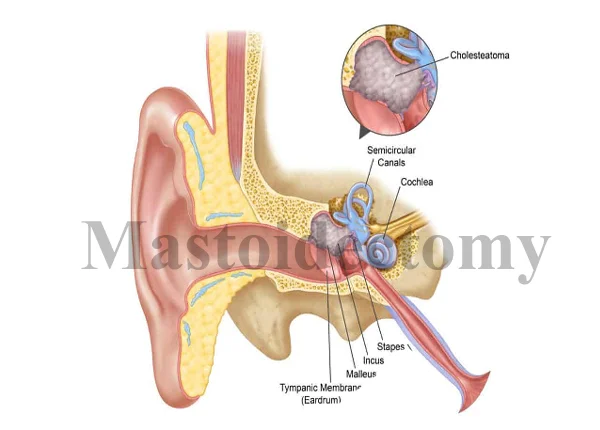 Mastoid Surgery