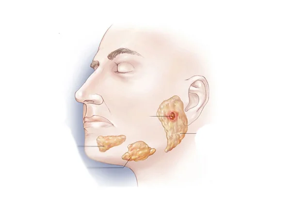 Parotid Surgery