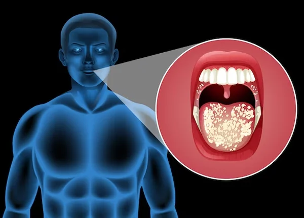 Oral Carcinoma