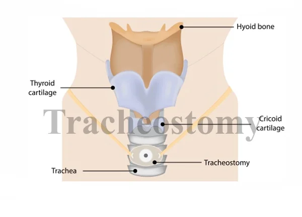 Tracheostomy