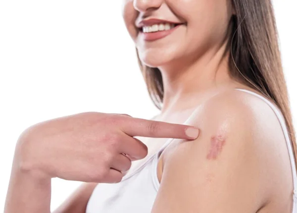 Keloid Removal